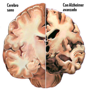 ALZHEIMER